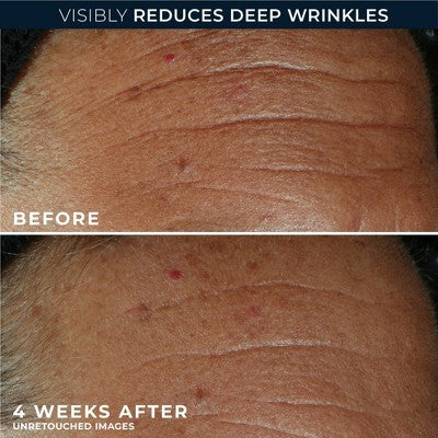 RoC Derm Correxion Fill + Treat Serum 0.5 fl oz - Imperfect Box