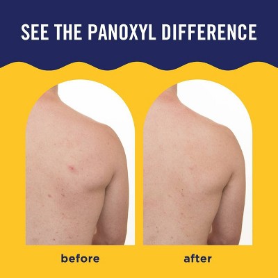 PanOxyl Acne Banishing Body Spray 2% Salicylic Acid 6oz - New